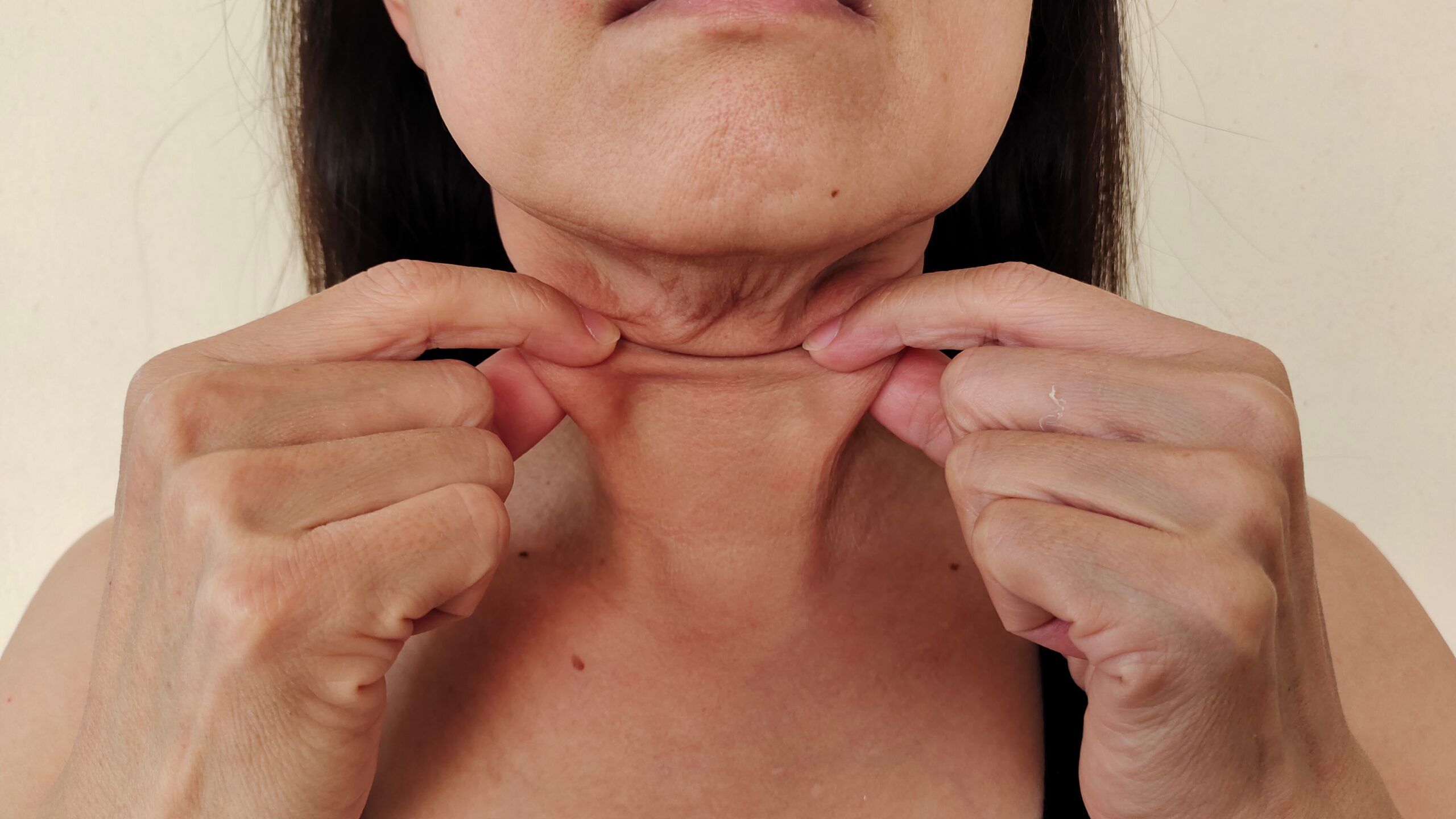 Portrait,Showing,The,Flabbiness,Adipose,Sagging,Skin,Under,The,Neck,