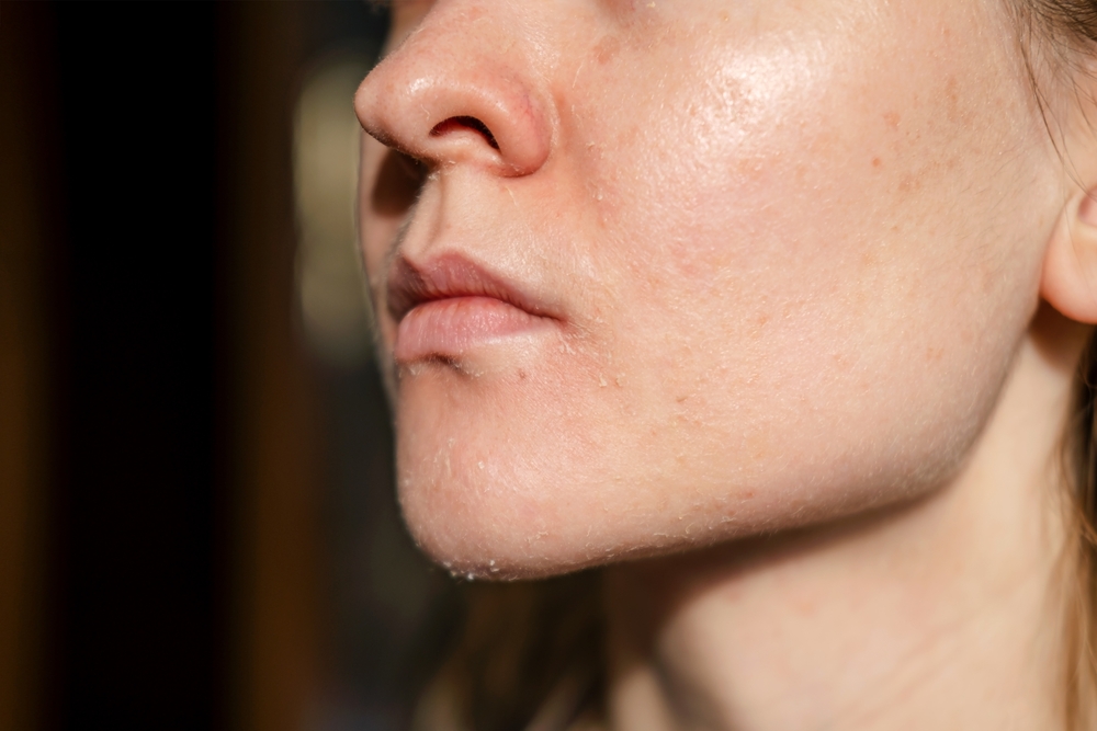 The,Woman,Skin,Flakes,Off,At,The,Mouth.,Dry,Skin.